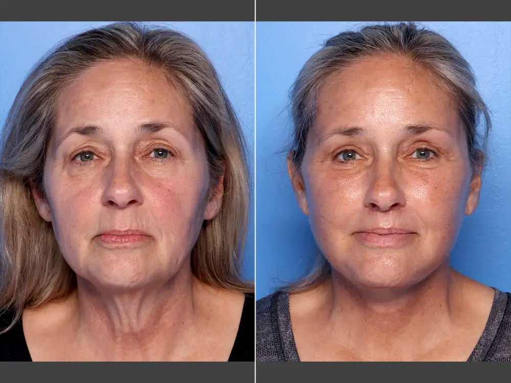 Naveen Setty, MD Face Lift Before & After Photo