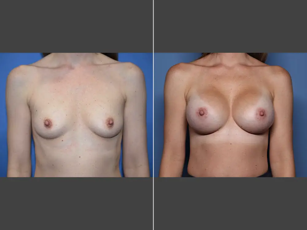 Naveen Setty, MD Breast Augmentation Before & After Photo