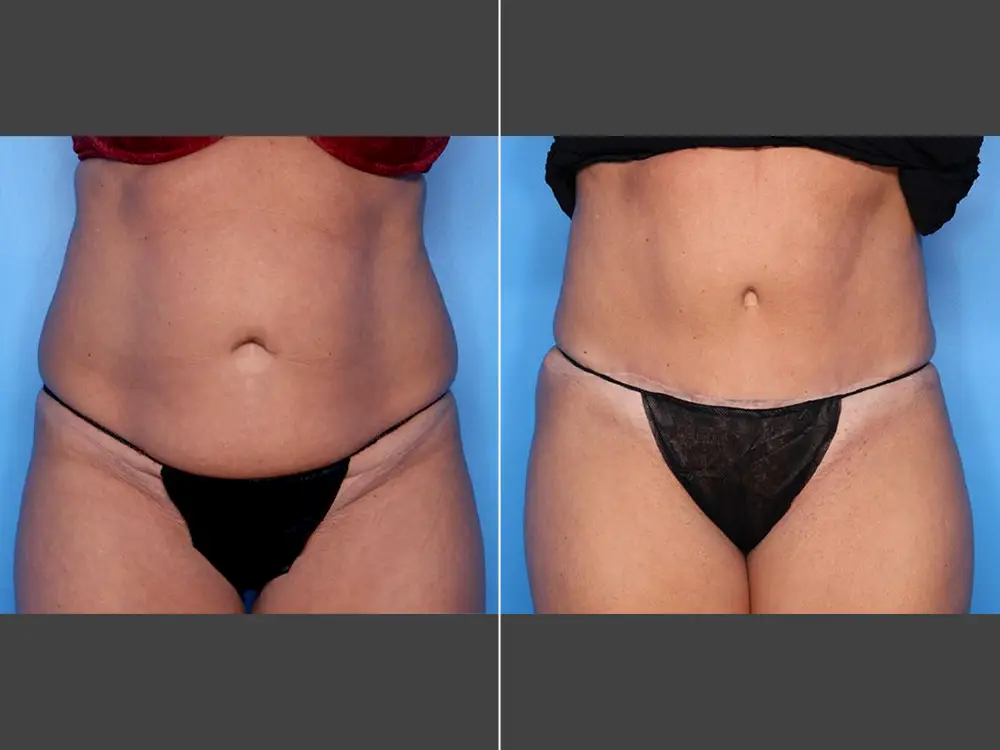 Naveen Setty, MD Tummy Tuck / Abdominoplasty and Liposuction Before & After Photo