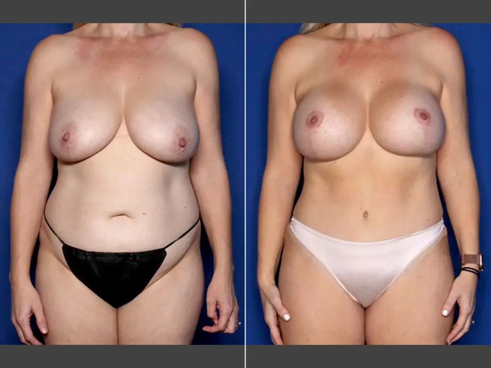 Naveen Setty, MD Mommy Makeover Before & After Photo