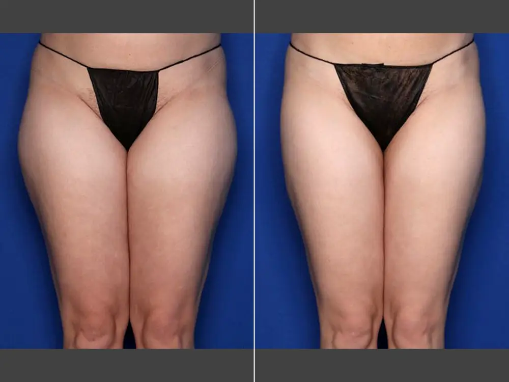 Naveen Setty, MD Liposuction Before & After Photo