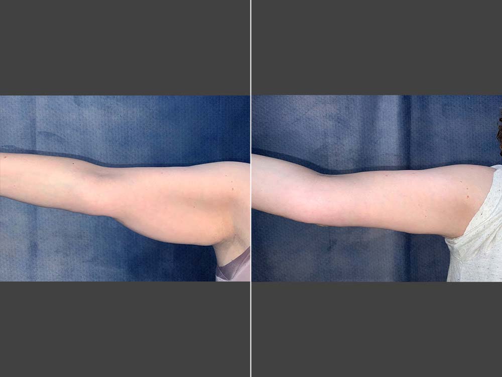 Mark Boschert, MD Arm Lift Before and After Photo Front - Case 01