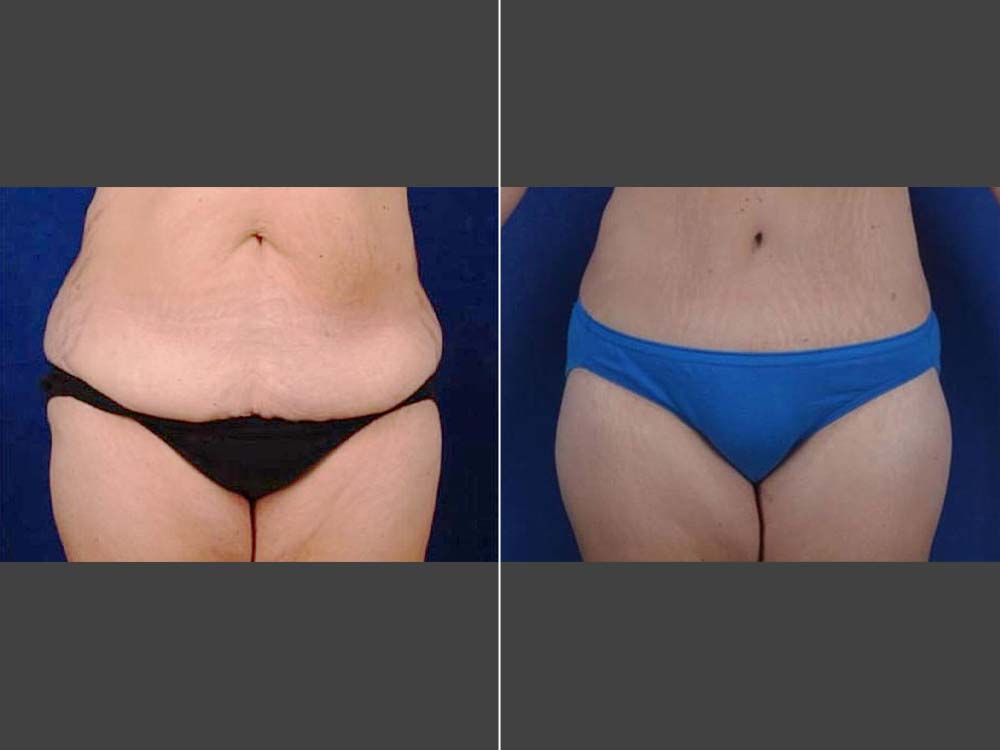 Mark Boschert, MD Body Lift Before and After Photo Front - Case 01