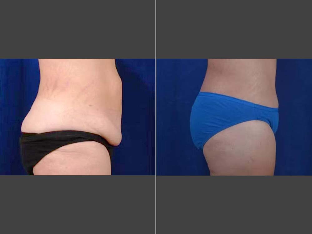 Mark Boschert, MD Body Lift Before and After Photo Side - Case 01