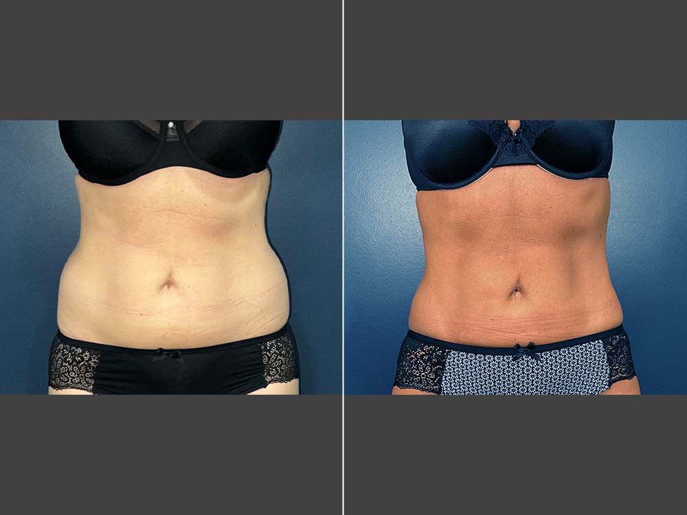 Mark Boschert, MD Liposuction Before and After Photo Front - Case 01