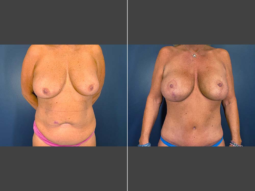 Stefan Craig, MD Mommy Makeover Before and After Photo Front - Case 01