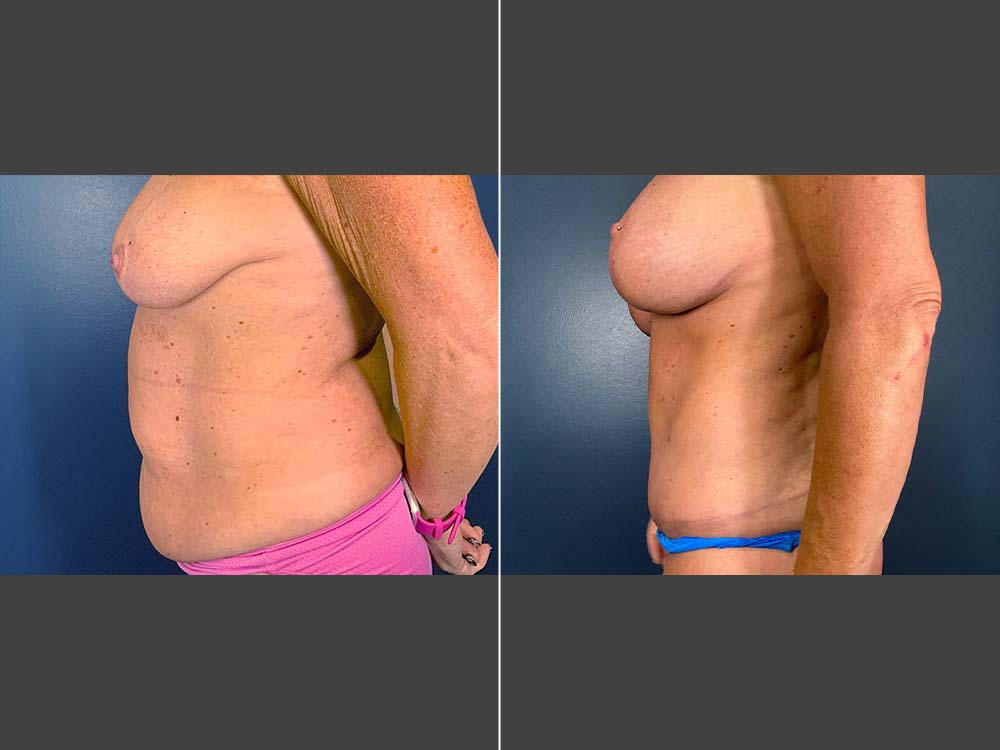 Stefan Craig, MD Mommy Makeover Before and After Photo Side - Case 01