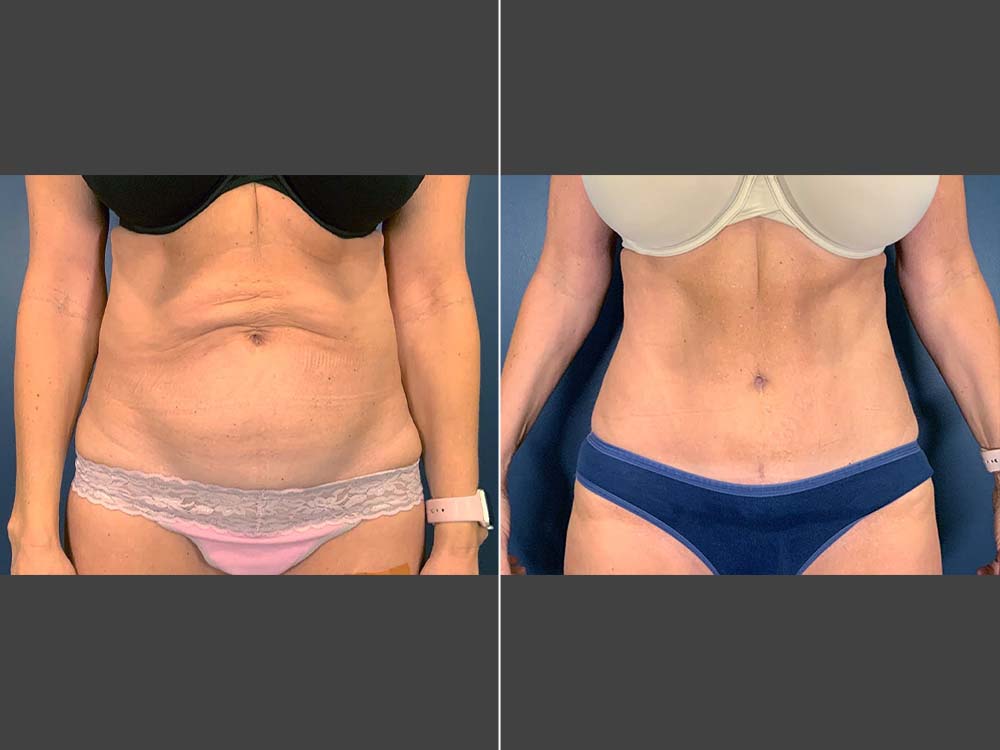 Stefan Craig, MD Tummy Tuck Before and After Photo Front - Case 01