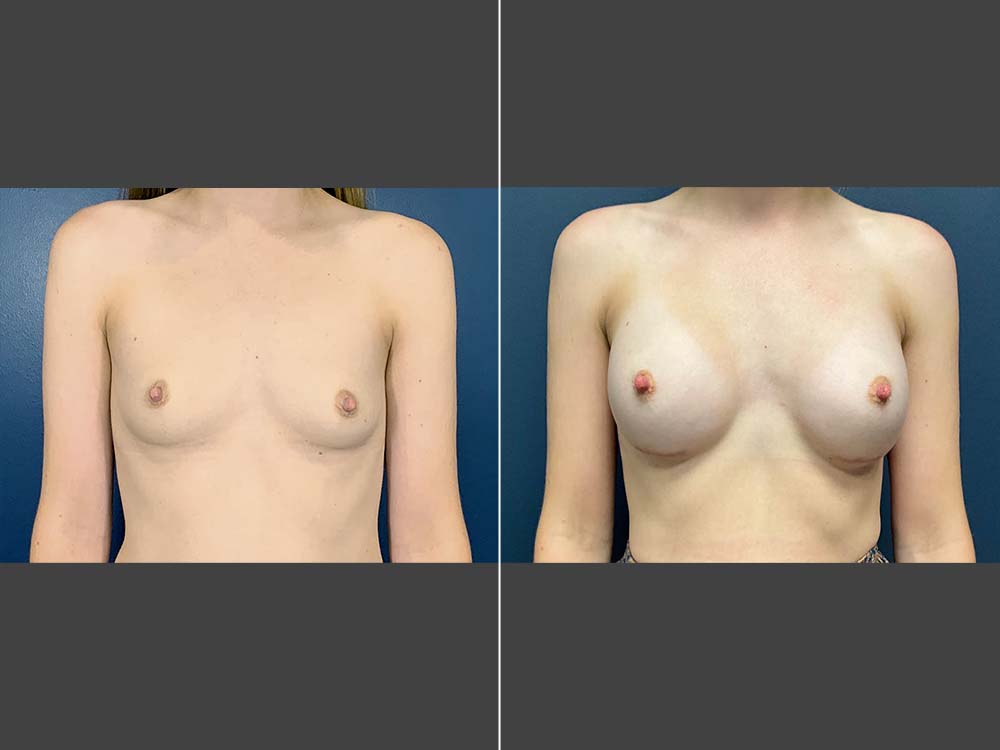 Mark Boschert, MD Breast Augmentation Before and After Photo Front - Case 01