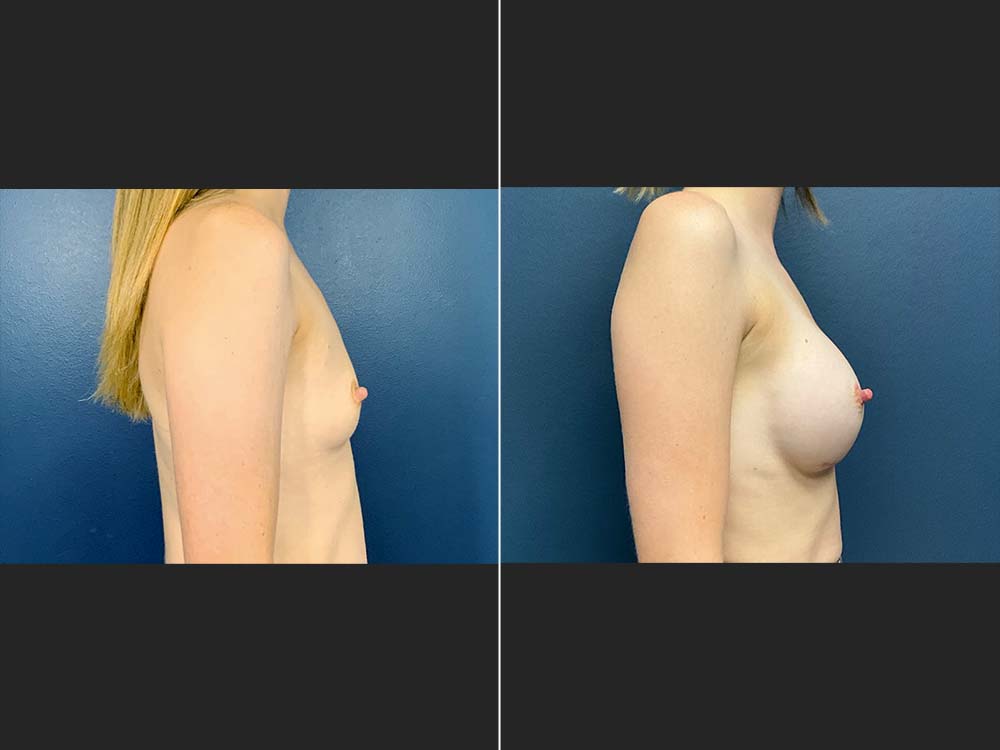 Mark Boschert, MD Breast Augmentation Before and After Photo Side - Case 01