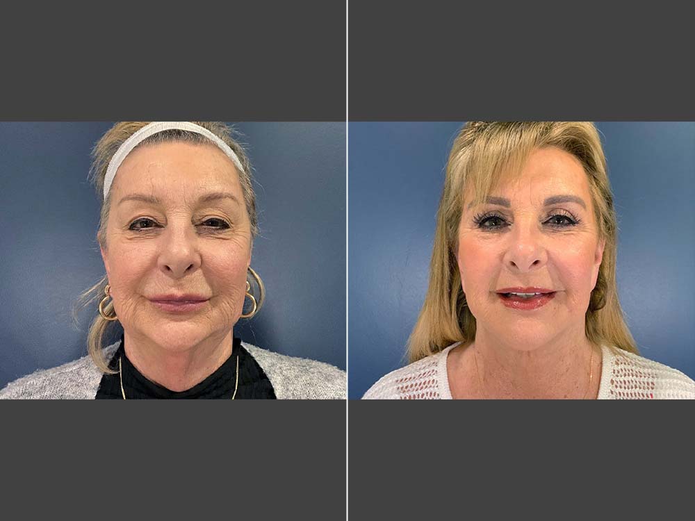 Stefan Craig, MD Face Lift Before and After Photo Front - Case 01