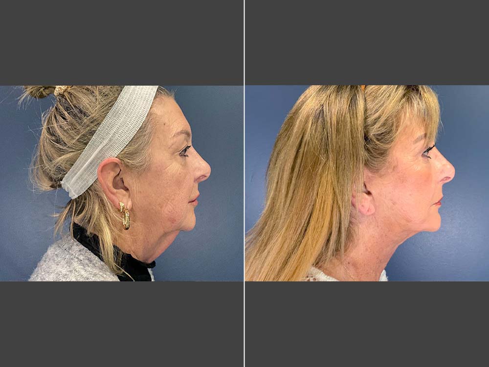 Stefan Craig, MD Face Lift Before and After Photo Side - Case 01