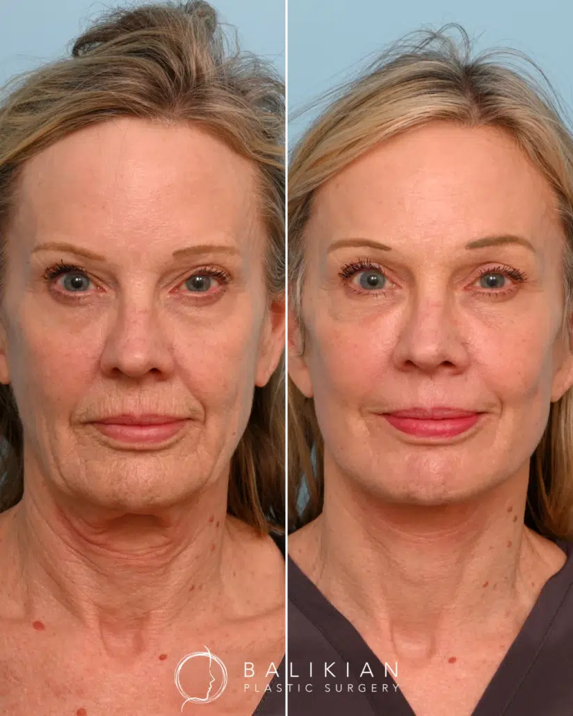 Richard Balikian, MD Face Lift, Neck Lift Before & After Photos, Case 01