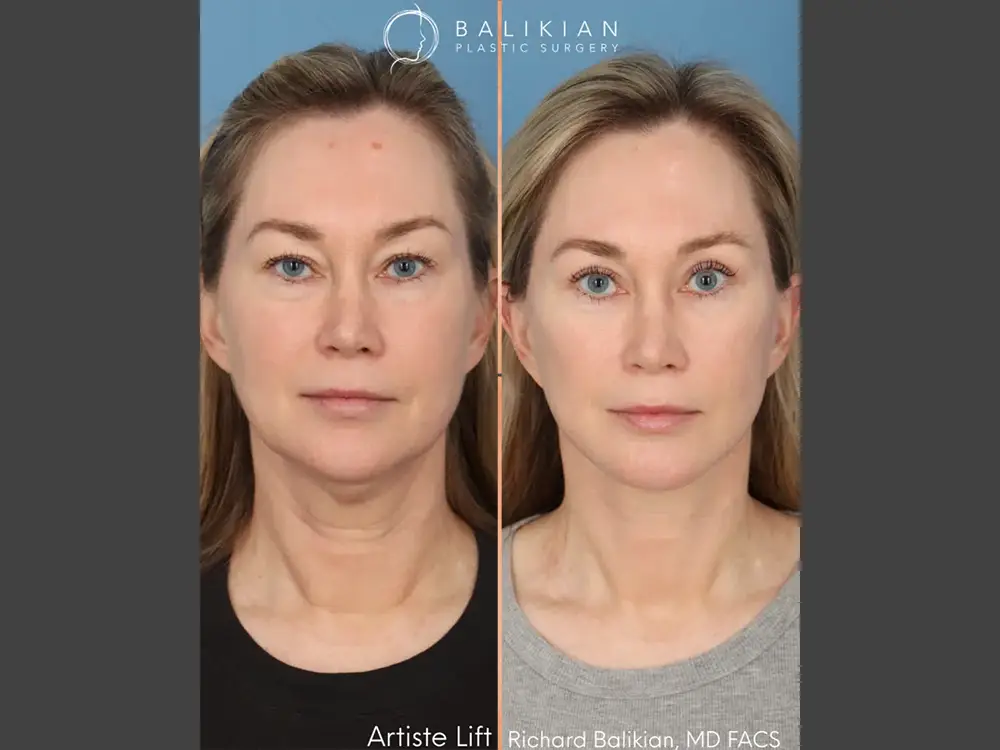 Richard Balikian, MD Face Lift, Neck Lift Before & After Photos, Case 02