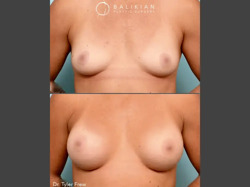 Tyler Frew, MD Breast Augmentation Before & After Photo, Case 01