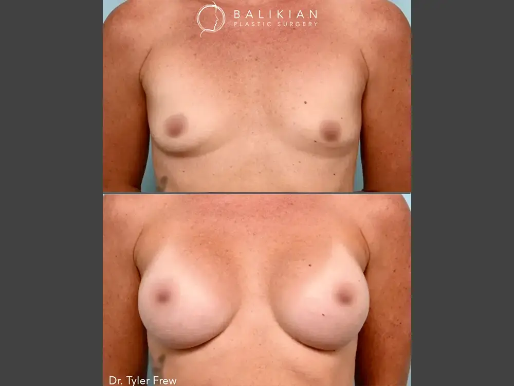 Tyler Frew, MD Breast Augmentation Before & After Photo, Case 02