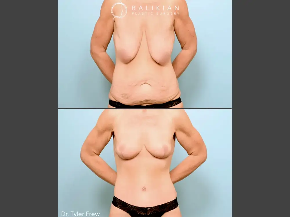 Tyler Frew, MD Mommy Makeover Before & After Photo, Case 01