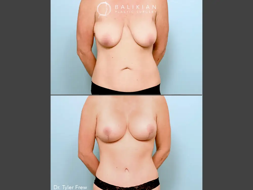 Tyler Frew, MD Mommy Makeover Before & After Photo, Case 02