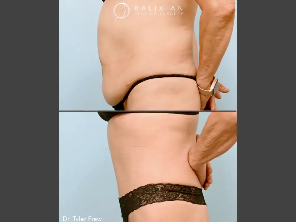 Tyler Frew, MD Liposuction Before & After Photo, Case 01