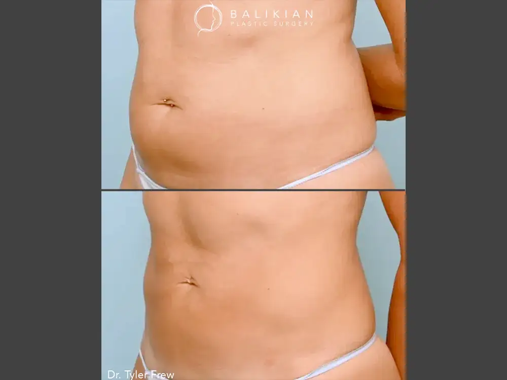 Tyler Frew, MD Liposuction Before & After Photo, Case 02