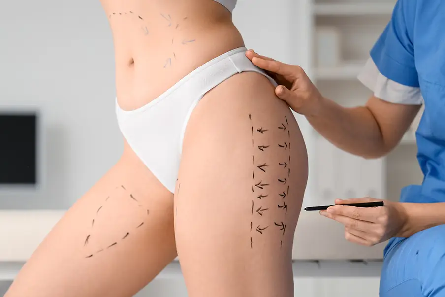 Liposuction