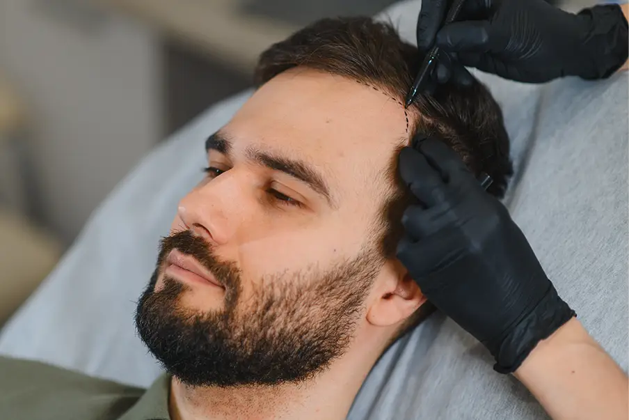 Follicular Unit Hair Transplantation (FUT)