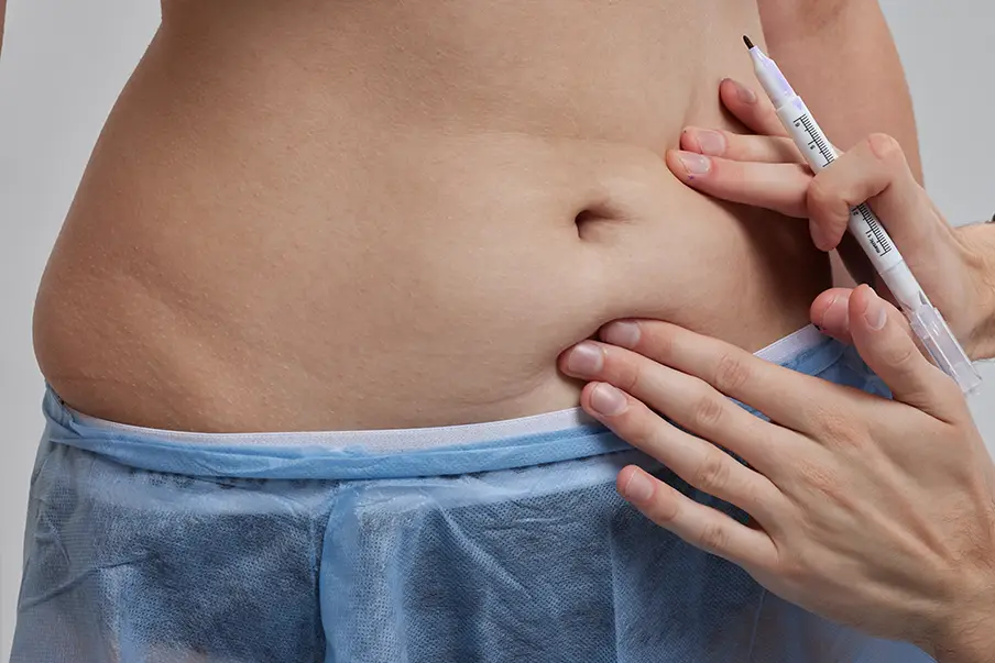 Tummy Tuck / Abdominoplasty