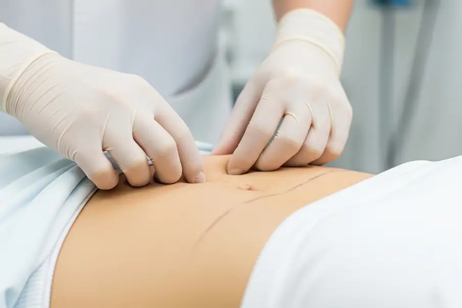 Liposculpture / Abdominal Etching
