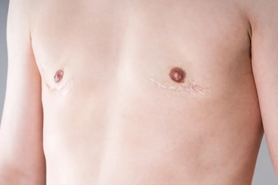 FTM Mastectomy (Top Surgery)