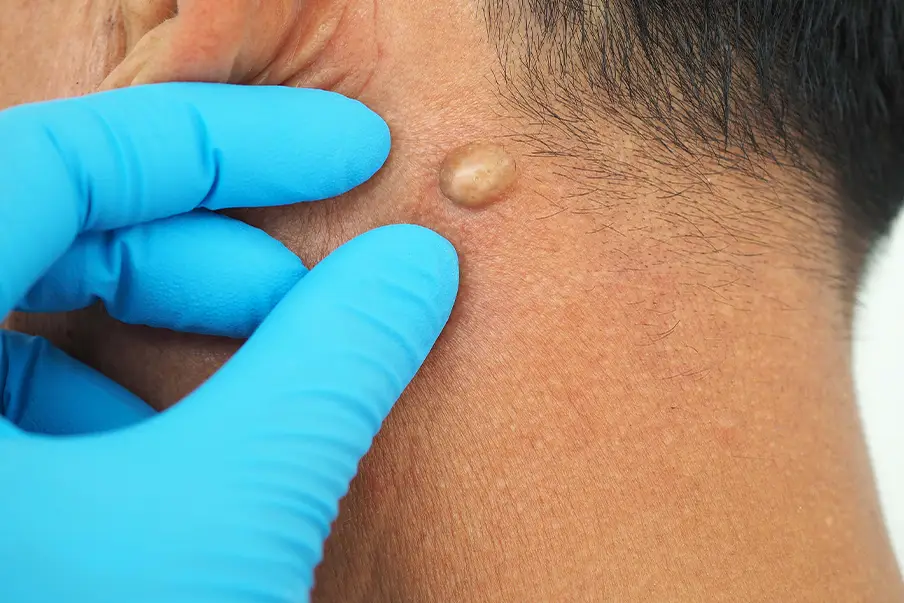 Cyst Removal
